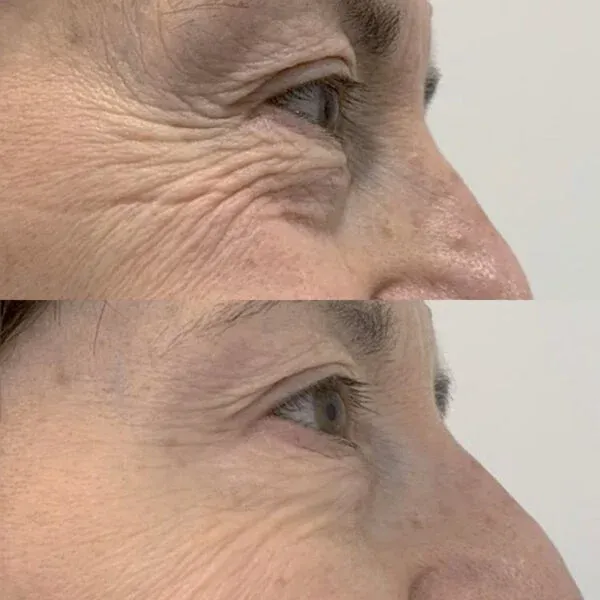 results of Skin Boosters