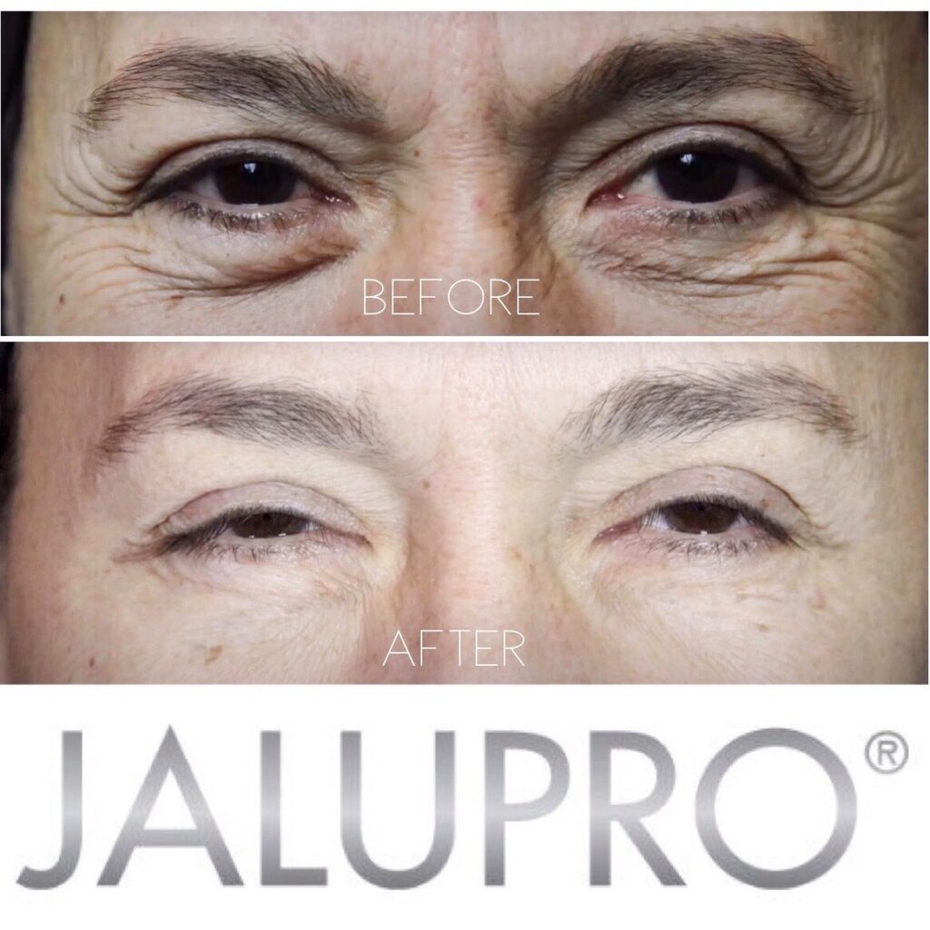 Jalupro before and after
