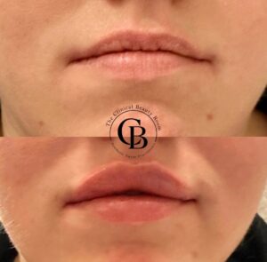 Lips Dermal Filler before and after