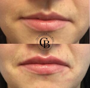 Dermal Filler before and after