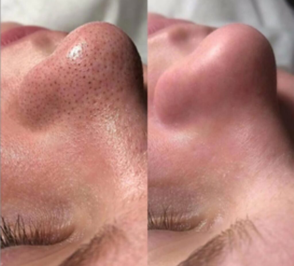 Facial before and after