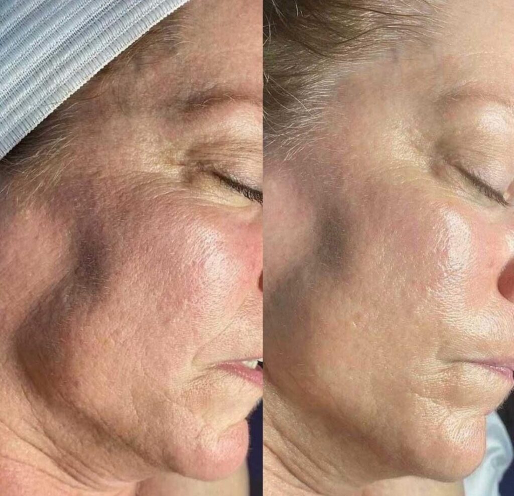 Facial Treatment