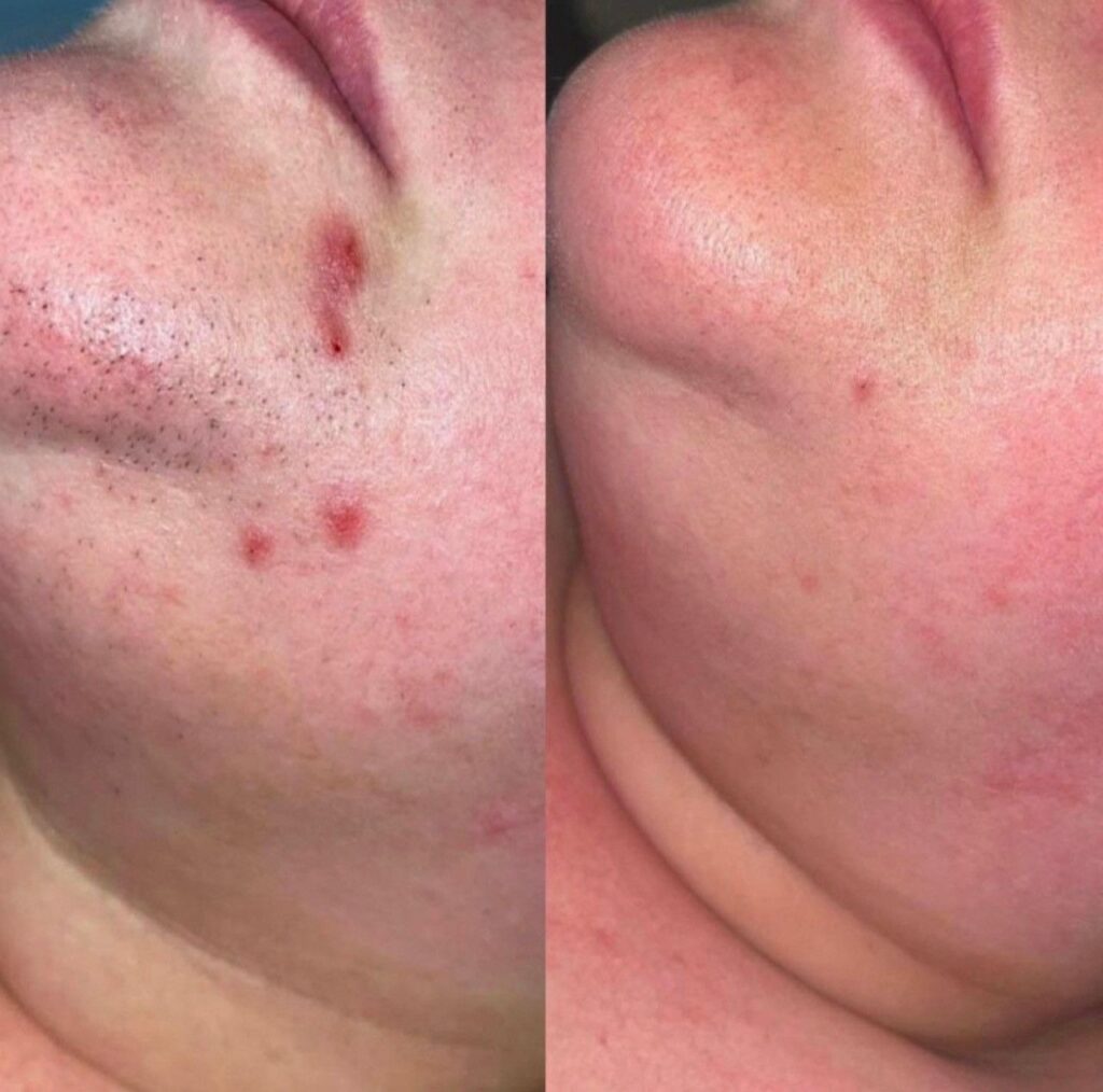 Laser Hair Removal face