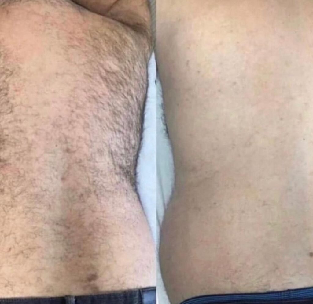 Laser Hair Removal back