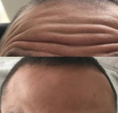 Before and after Anti-wrinkle Treatment