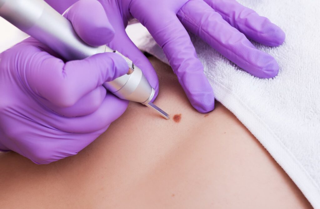 Skin Lesion Removal