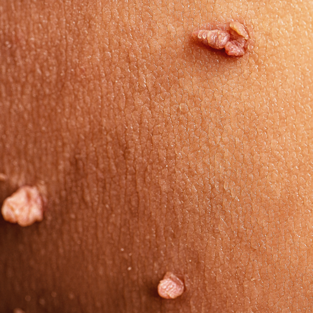 Skin Tag