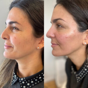 side view of Dermal Filler results