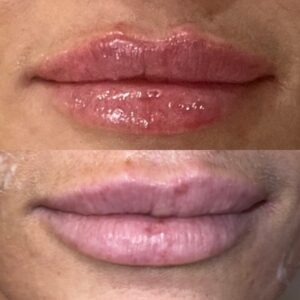 Before and after Dermal Filler Lips