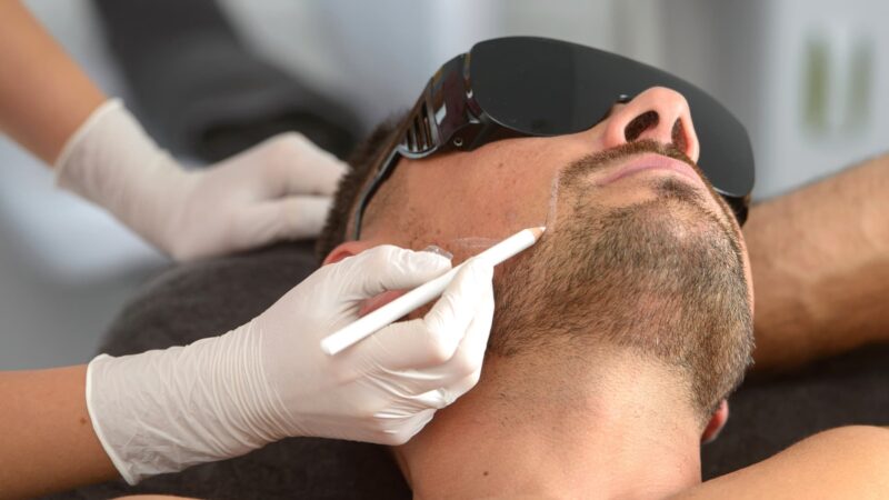 Beard laser hair