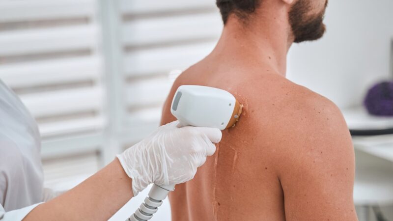 Male Laser Hair Removal Back